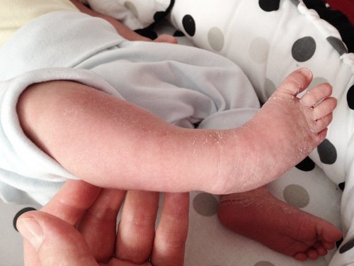 krzywa stopa, stopa konsko-szpotawa, stopa końsko-szpotawa, stopy konsko-szpotawe, stopy końsko-szpotawe, clubfoot, clubfeet, stopa ułożeniowa, stopa habitualna, wada ułożeniowa, positional clubfoot
