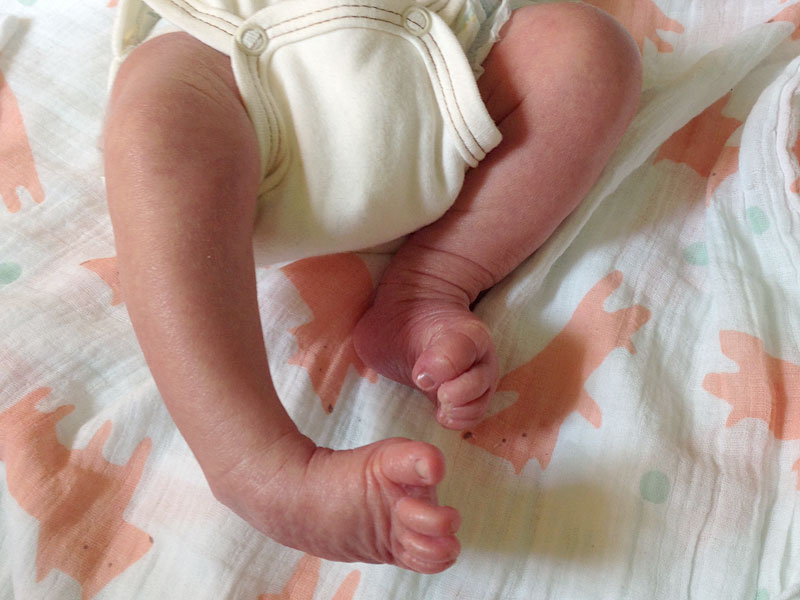 krzywa stopa, stopa konsko-szpotawa, stopa końsko-szpotawa, stopy konsko-szpotawe, stopy końsko-szpotawe, clubfoot, clubfeet, stopa ułożeniowa, stopa habitualna, wada ułożeniowa, positional clubfoot