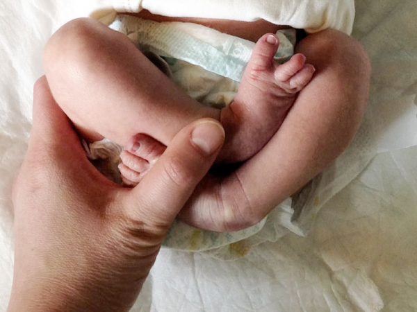 wada-ulozeniowa krzywa stopa, stopa konsko-szpotawa, stopa końsko-szpotawa, stopy konsko-szpotawe, stopy końsko-szpotawe, clubfoot, clubfeet, stopa ułożeniowa, stopa habitualna, wada ułożeniowa, positional clubfoot